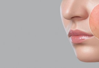 Allergie: Frau mit allergischer Reaktion im Gesicht