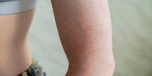 Hyperkeratose: Verhornung der Haut am Arm