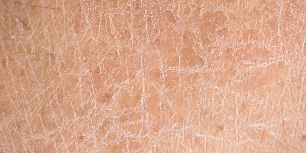 Les Rugosites De La Peau Combattre La Desquamation Par L Hydratation les-rugosites-de-la-peau-combattre-la-desquamation-par-l-hydratation