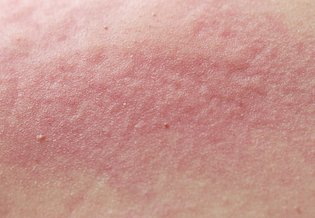 Larocheposay ArticlePage Allergic Only dry skin is reactive