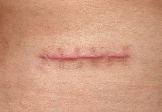 Larocheposay ArticlePage Damaged Scar from stitches How to prevent it