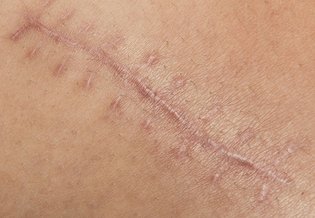 Larocheposay ArticlePage Damaged Skin Voyager