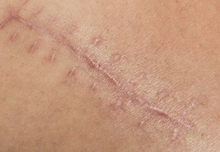 Larocheposay ArticlePage Damaged Skin Voyager