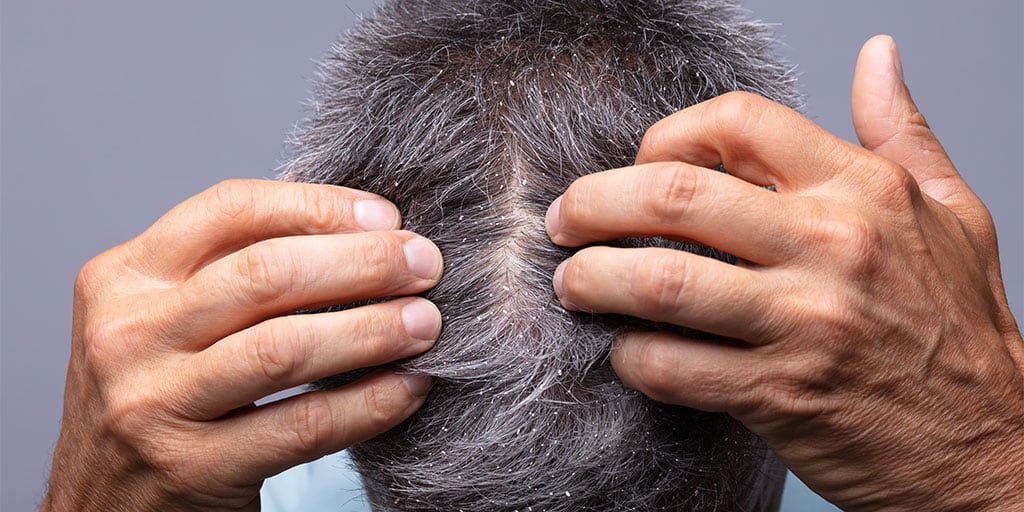 Juckende Kopfhaut behandeln So geht es Ursachen, Pflegelösungen, Produckte von La RochePosay