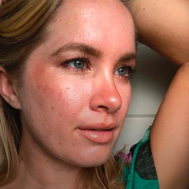 La-Roche-Posay-cover-video-Acne 1