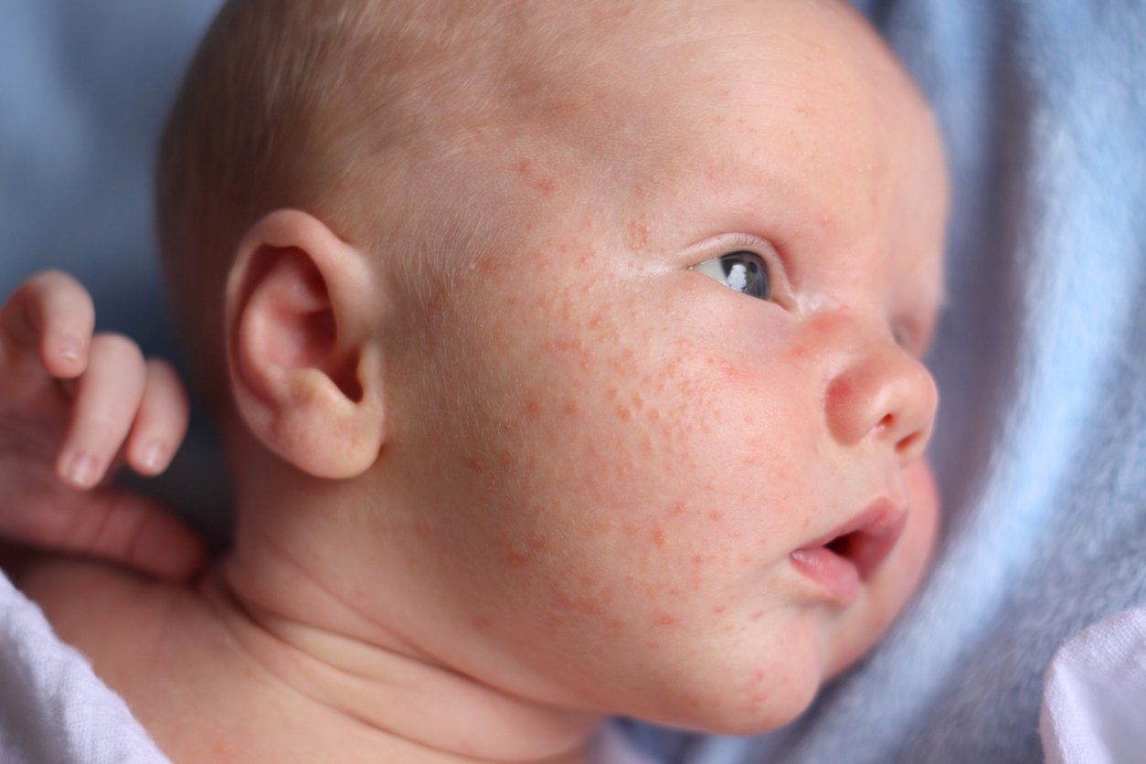 Baby mit roten Pickeln im Gesicht