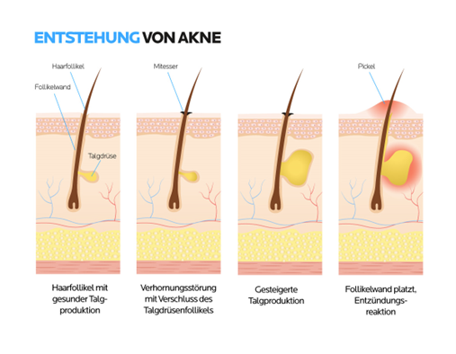 Grafik: Entstehung von Mitessern und Pickeln