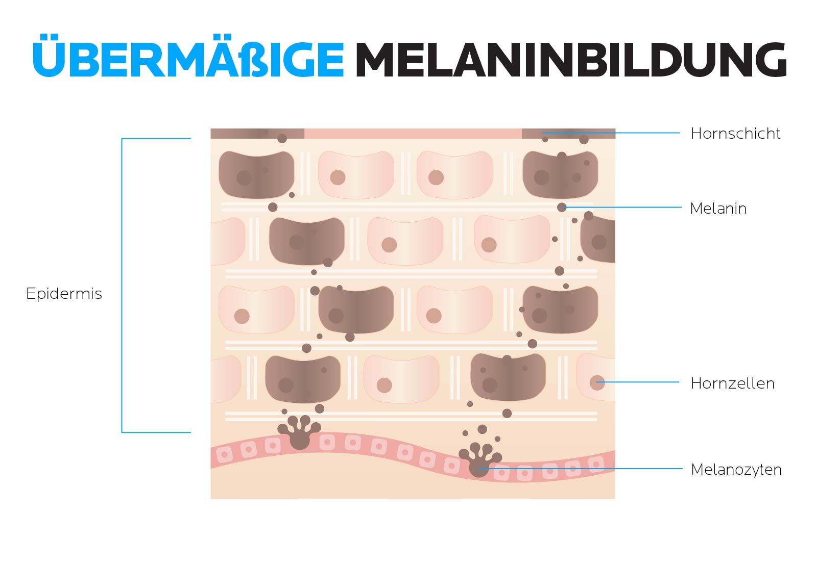 Übermäßige Melaninbildung als Grund für Hyperpigmentierung