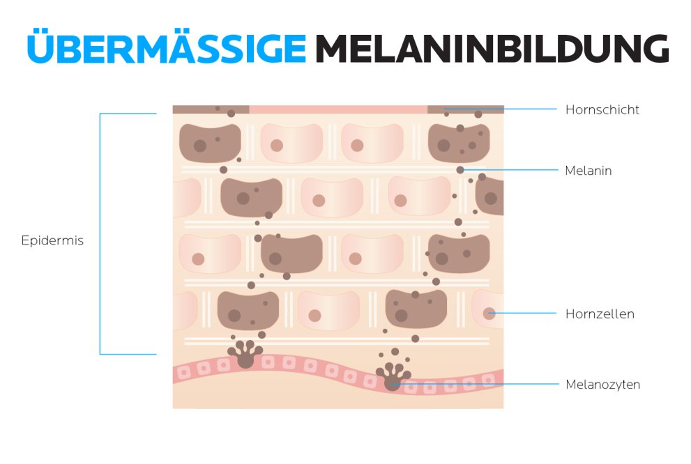Zeigt eine grafische Darstellung von Hautschichten, wenn eine übermässige Melaninbildung stattfindet