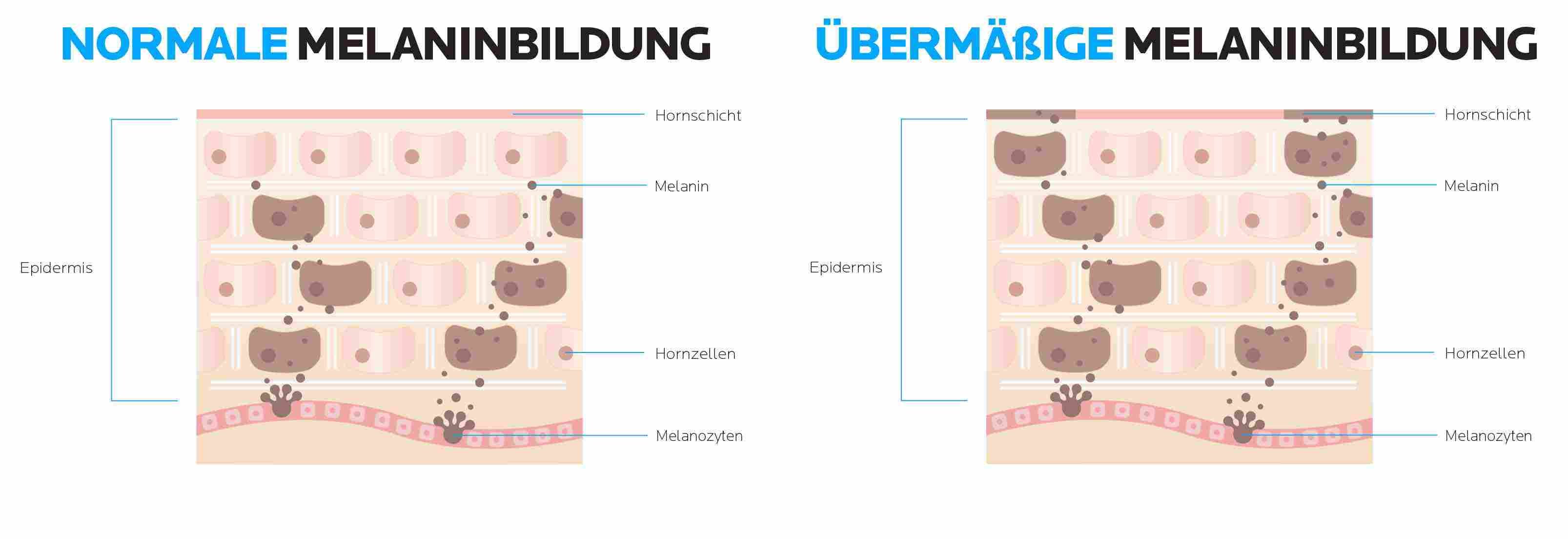 Grafik mit einem Vergleich von normaler und übermäßiger Melaninbildung