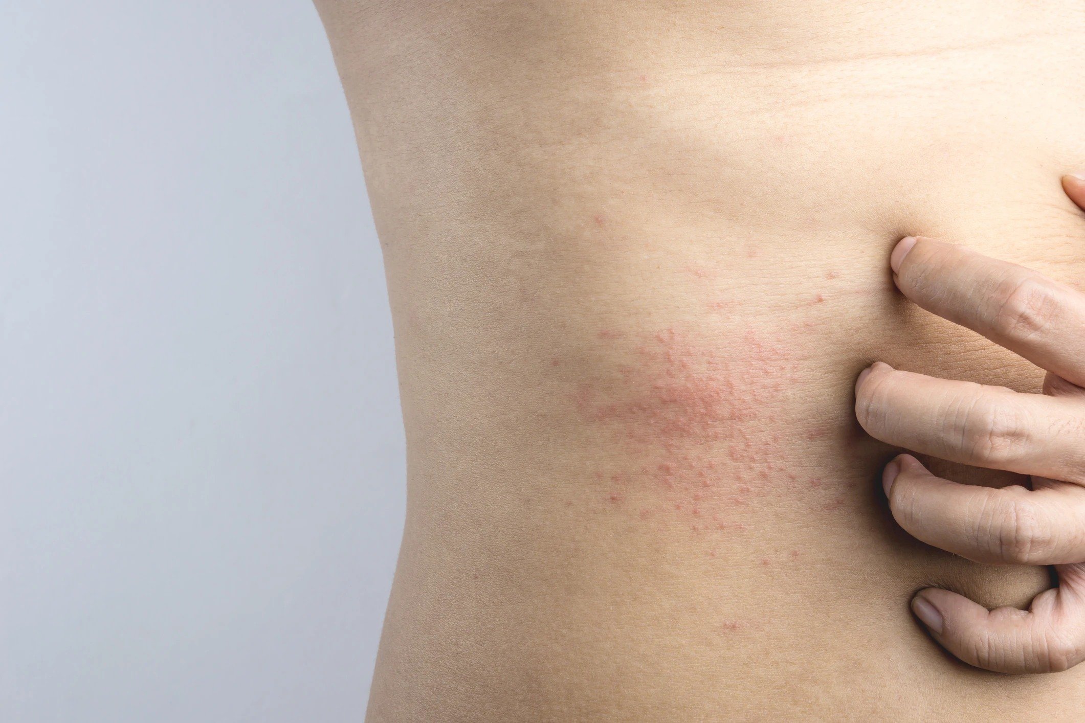 Ekzem am Bauch: Das hilft wirklich | La Roche Posay
