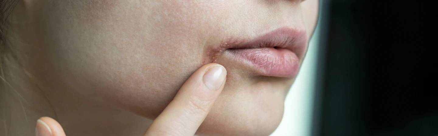 Neurodermitis an den Lippen