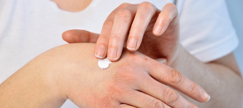 Ekzem an der Hand: Entstehung und Pflege | La Roche Posay