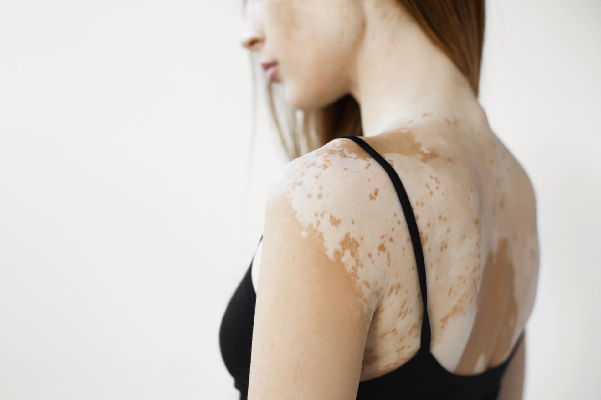 Frau mit Vitiligo (Weißfleckenkrankheit)