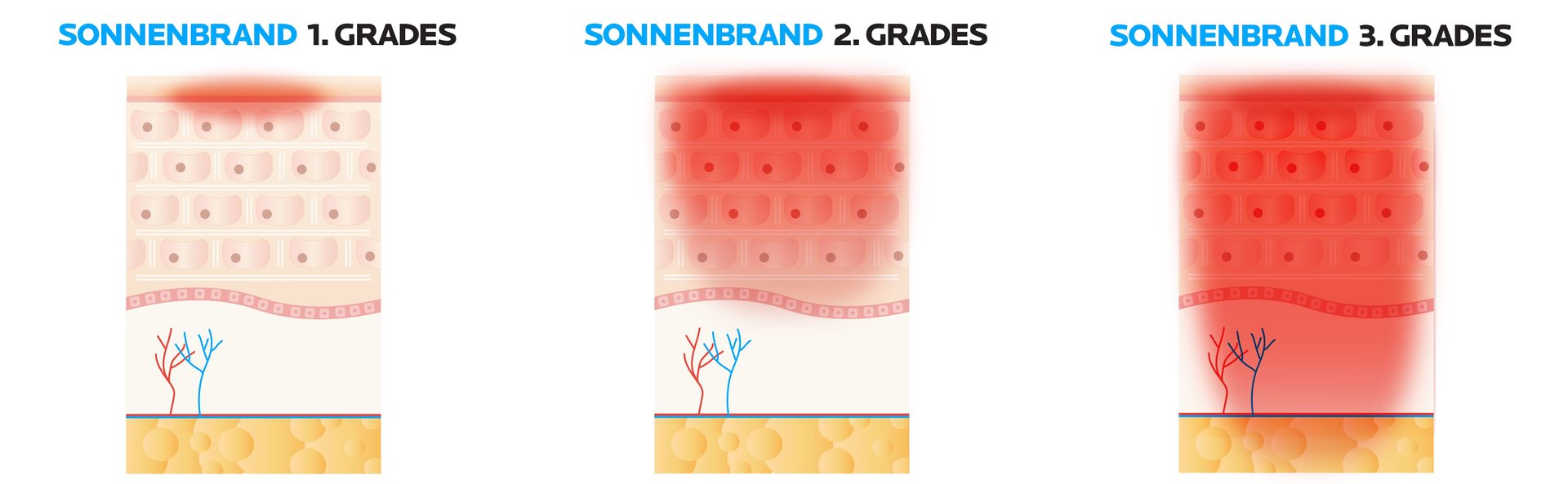 Sonnenbrand Grad eins bis 3