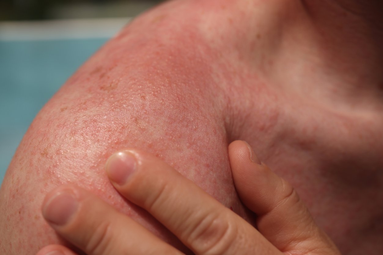 Antibiotiques et soleil : Peau rouge avec des cloques sur l'épaule