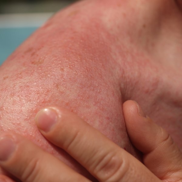 Gehört amoxicillin zu den fluorchinolone