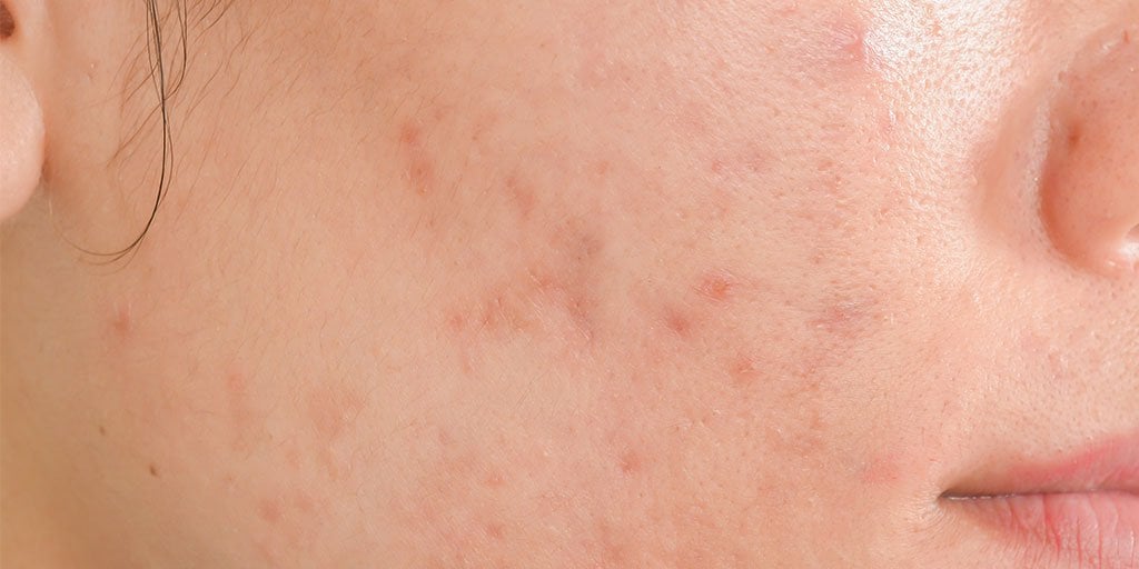 Larocheposay ArticlePage Acne How to get rid of scars and marks