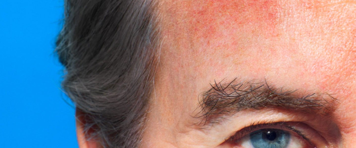 visage brûlé au troisième degré