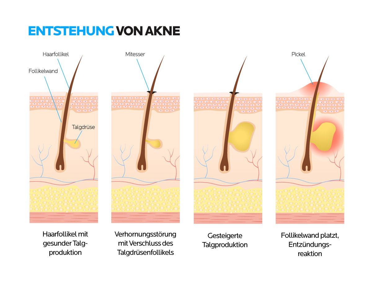 Die Entstehung von Akne, Pickeln und Mitessern