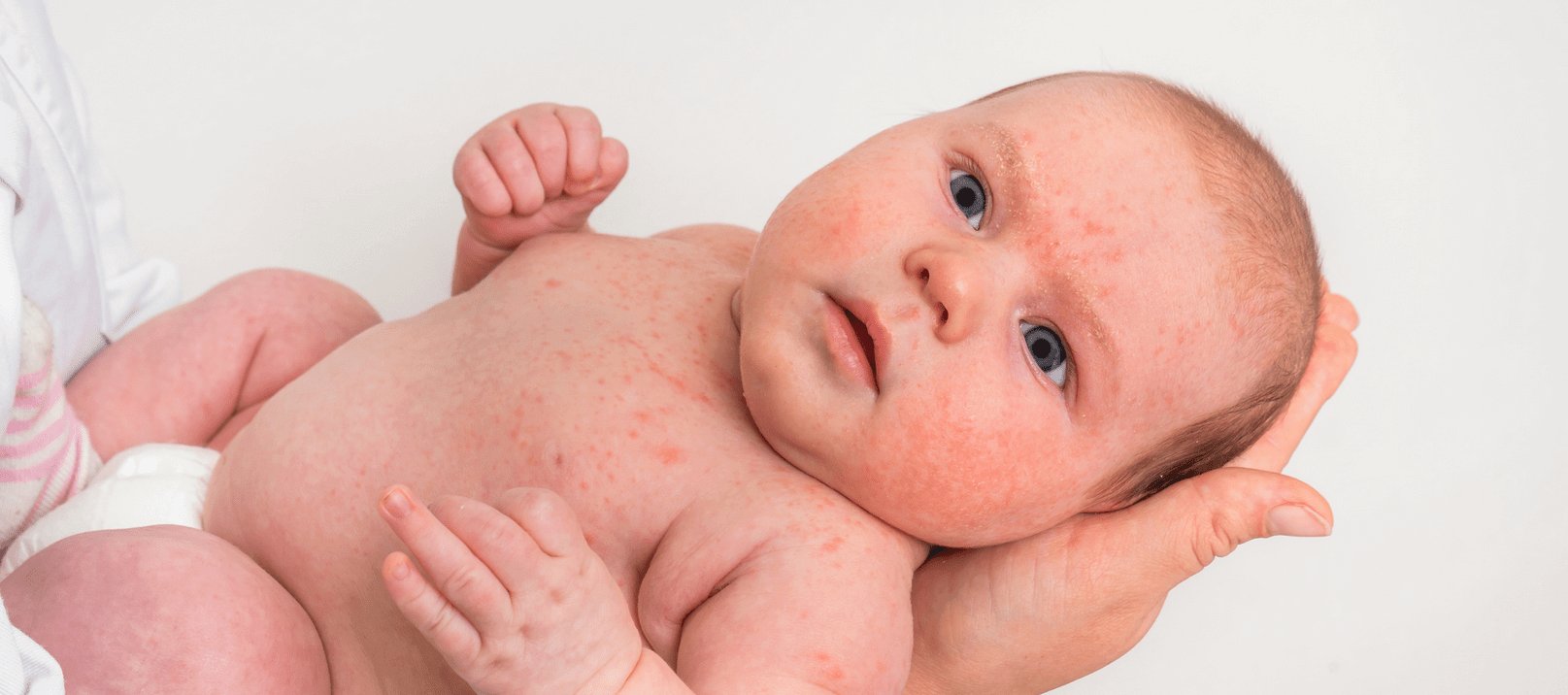 Baby mit Neugeborenenakne
