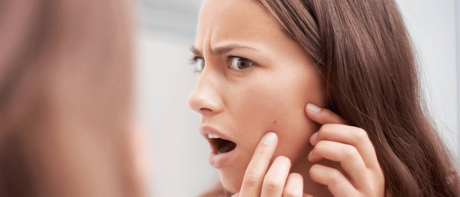 Peau à tendance acnéique : jeune femme avec des boutons sur la joue