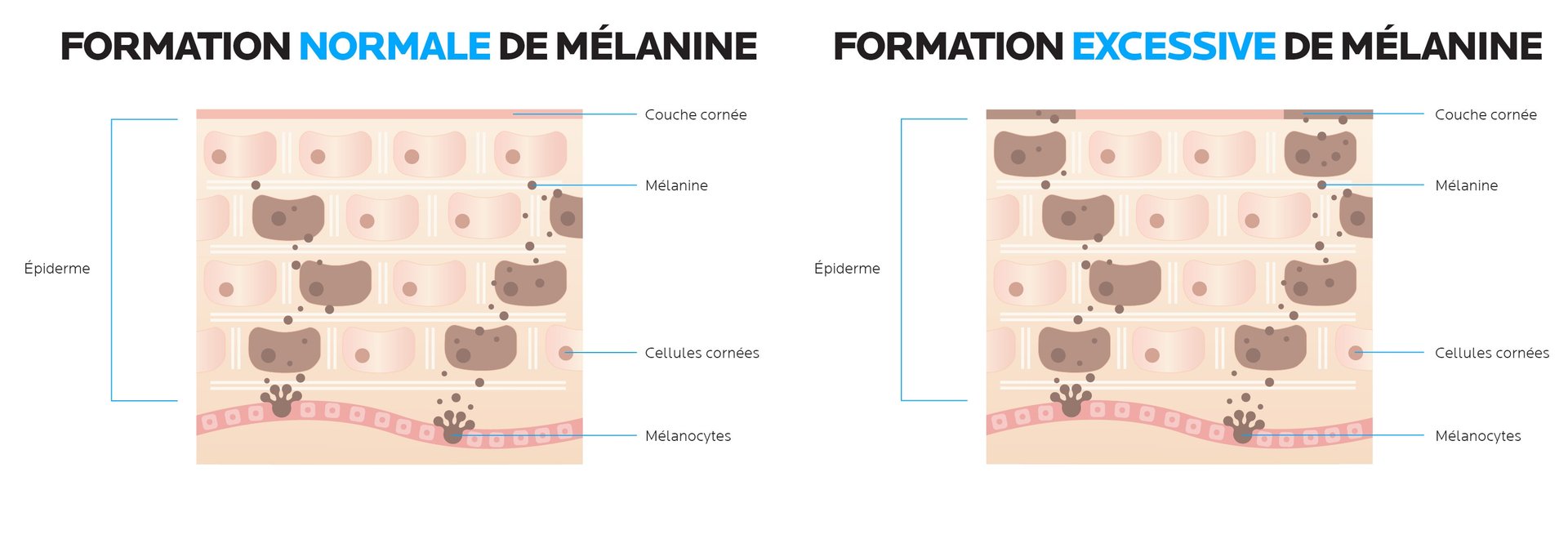 Les taches solaires et autres taches pigmentaires sont dues à une surproduction de mélanine