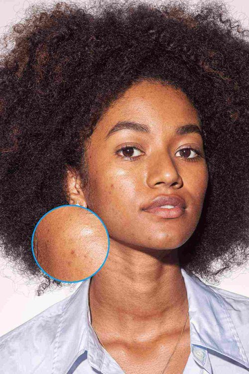 Hyperpigmentation post-inflammatoire : l’apparence des marques et cicatrices d’acné