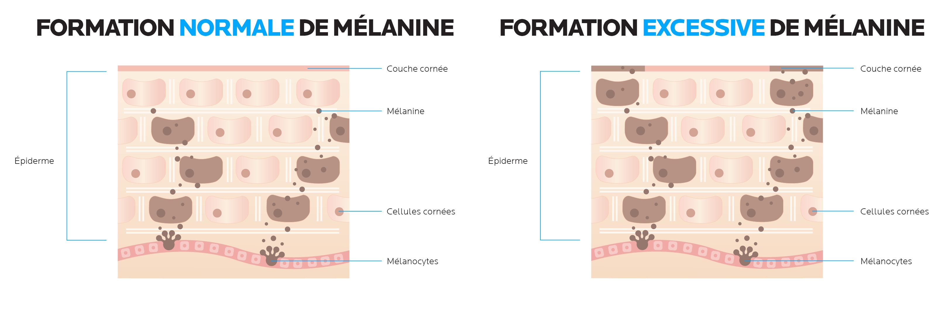 Origine des taches pigmentaires : production normale de mélanine vs surproduction  