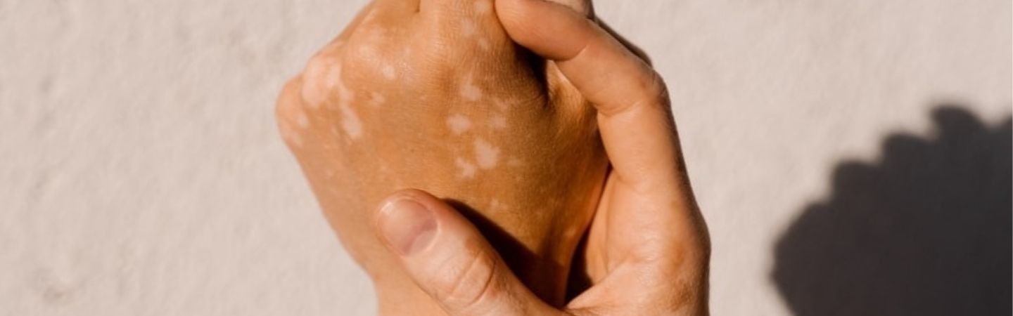 Vitiligo (maladie des taches blanches) au niveau des mains