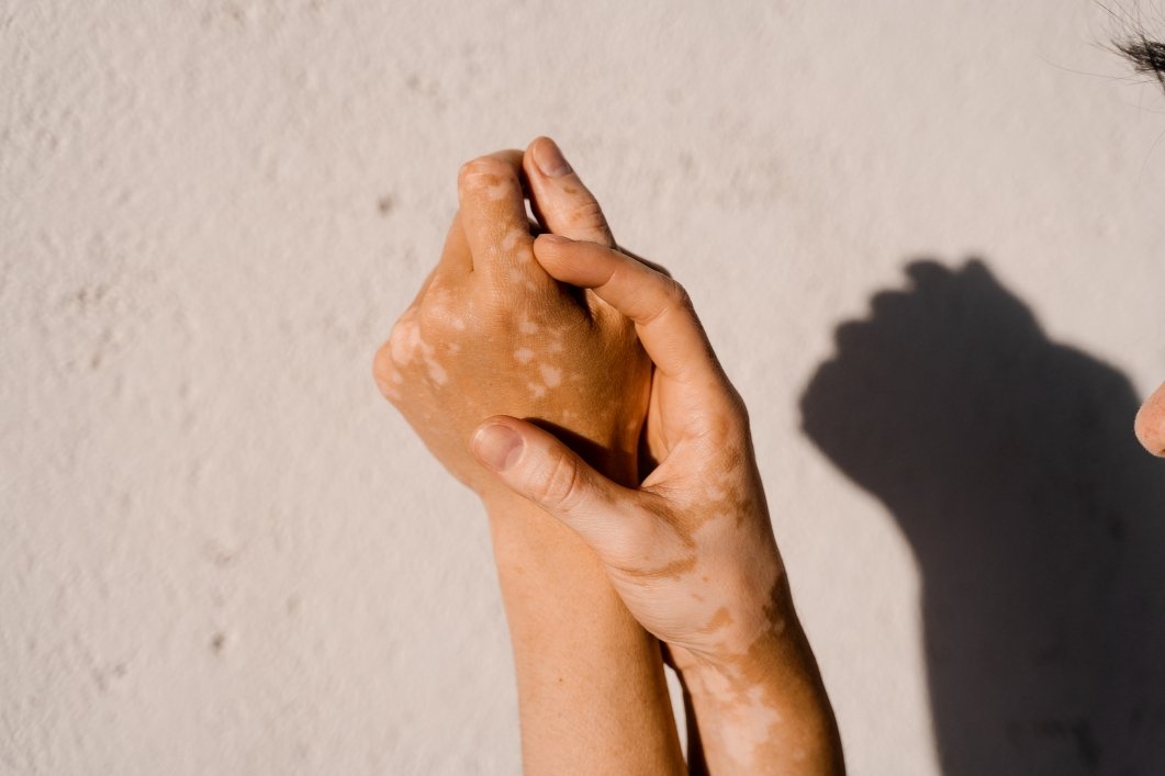 Vitiligo (Weissfleckenkrankheit) an den Händen