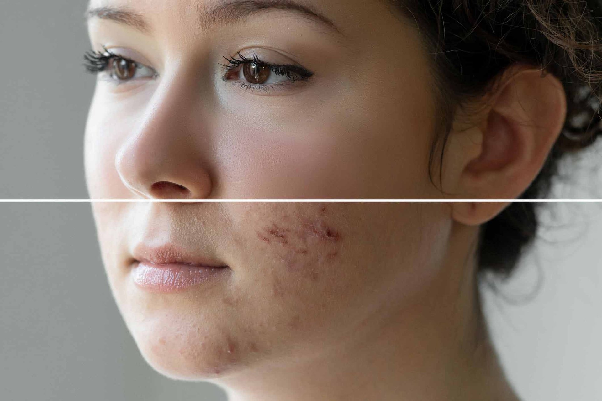 Narbenpflege : Ursachen, Pflegelsungen, Produckte von La Roche-Posay
