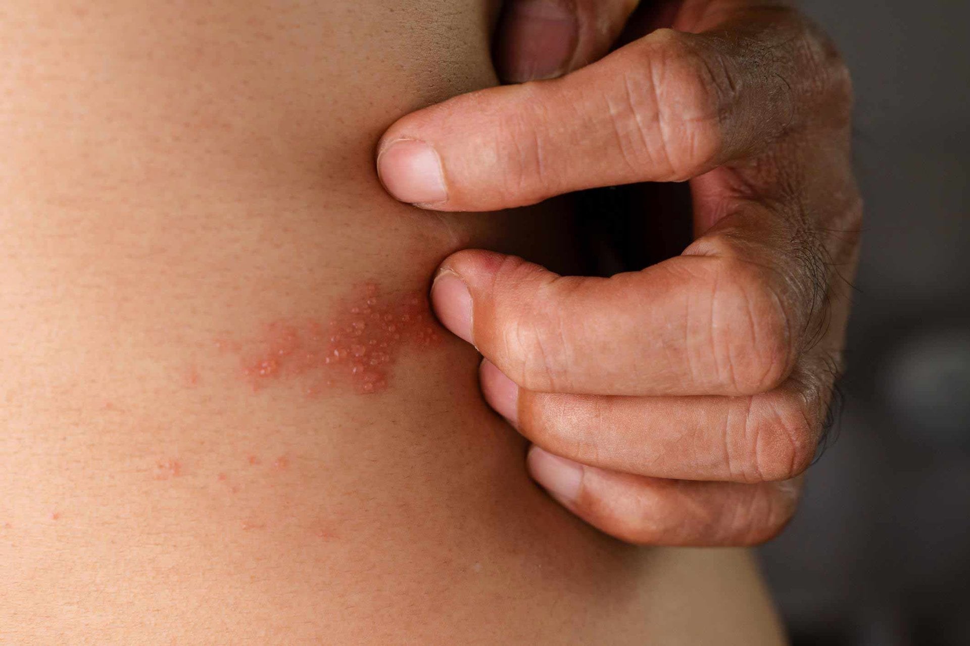 Männerhand umfasst die eigene Taille, um an eine kleine Stelle mit Gürtelrose zu fassen