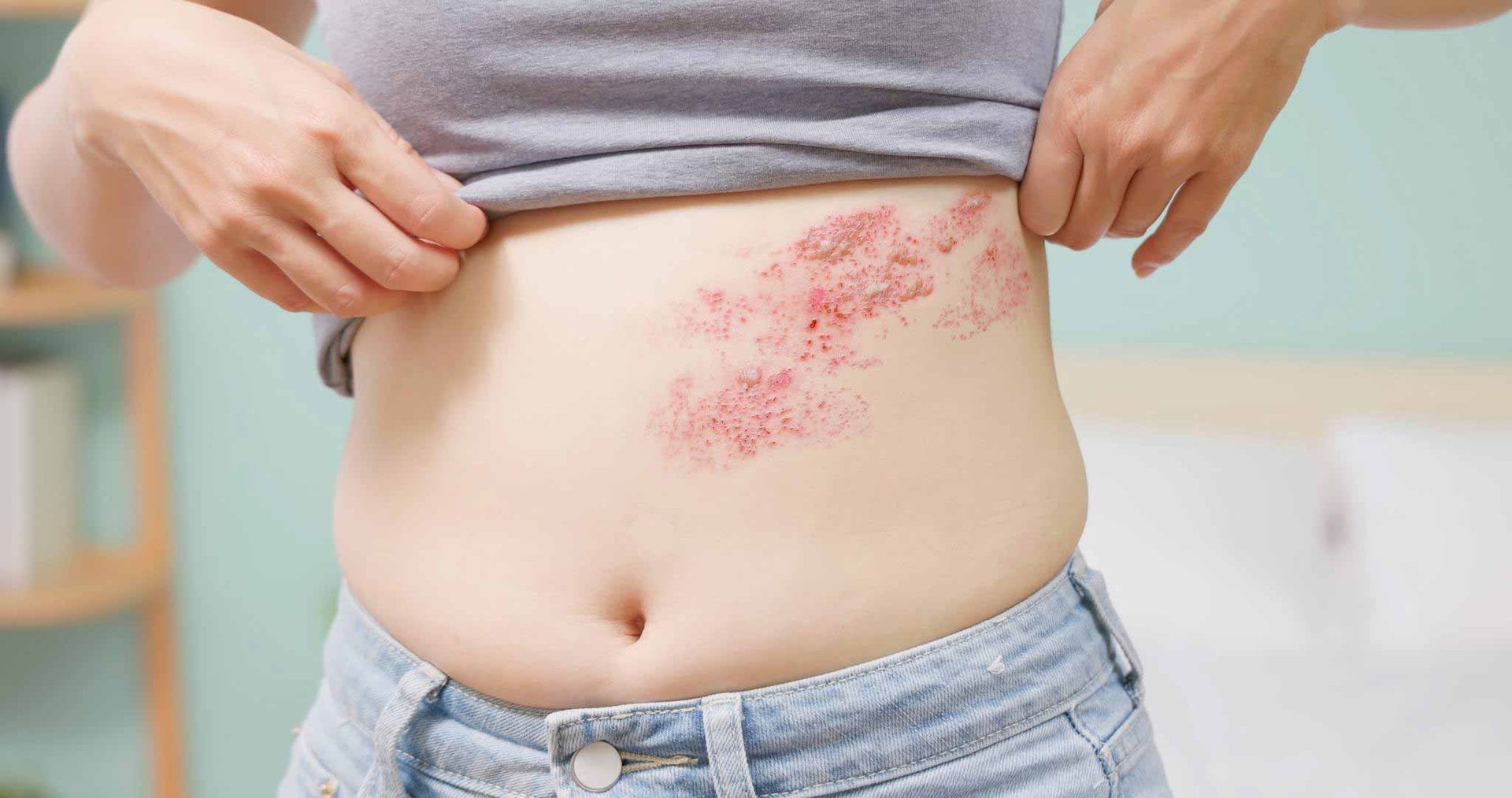 Frau hebt ihr graues Top an, um eine grosse Stelle mit verkrusteter Gürtelrose an ihrer linken Bauch-Hälfte zu zeigen