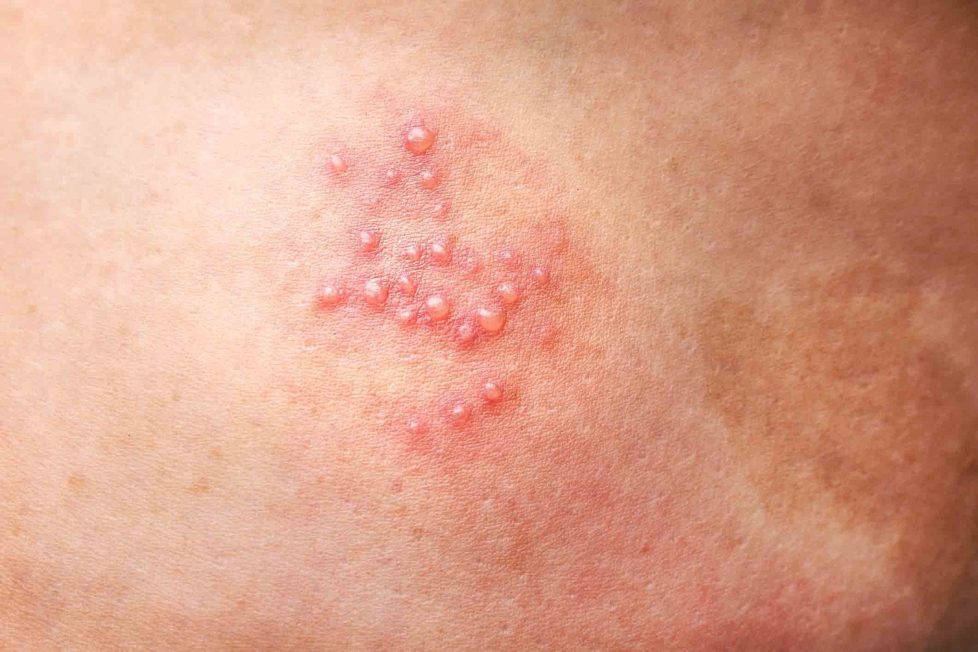 Gürtelrose Bläschen und leichte Rötung auf der Haut