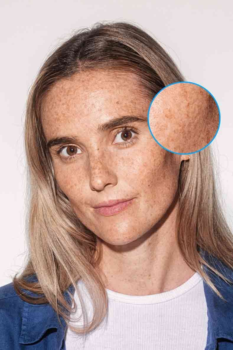 Hyperpigmentation : jeune femme avec des taches de rousseur