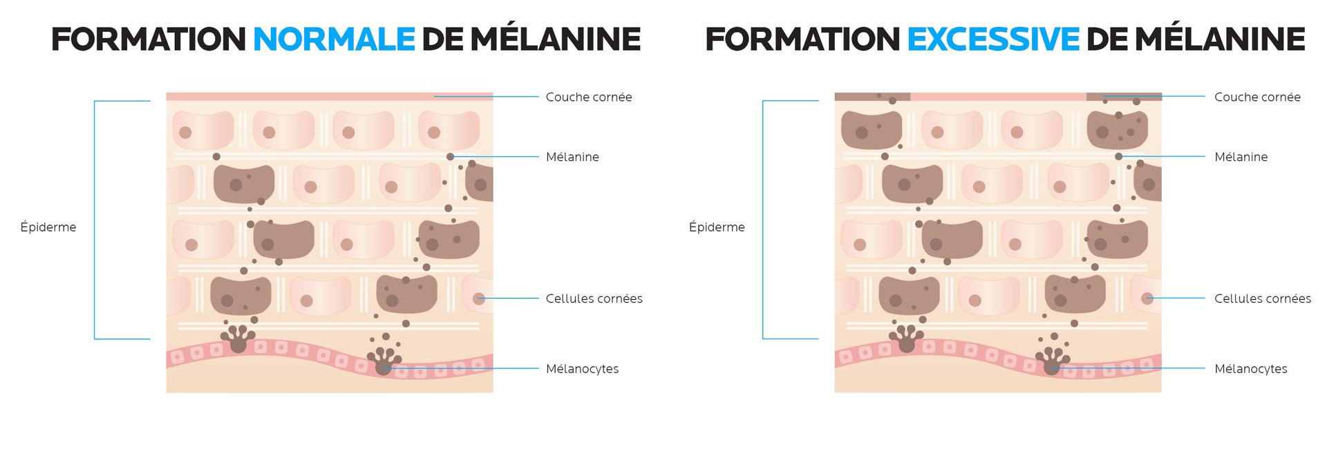 Production normale vs. production excessive de mélanine à l’origine des taches pigmentaires
