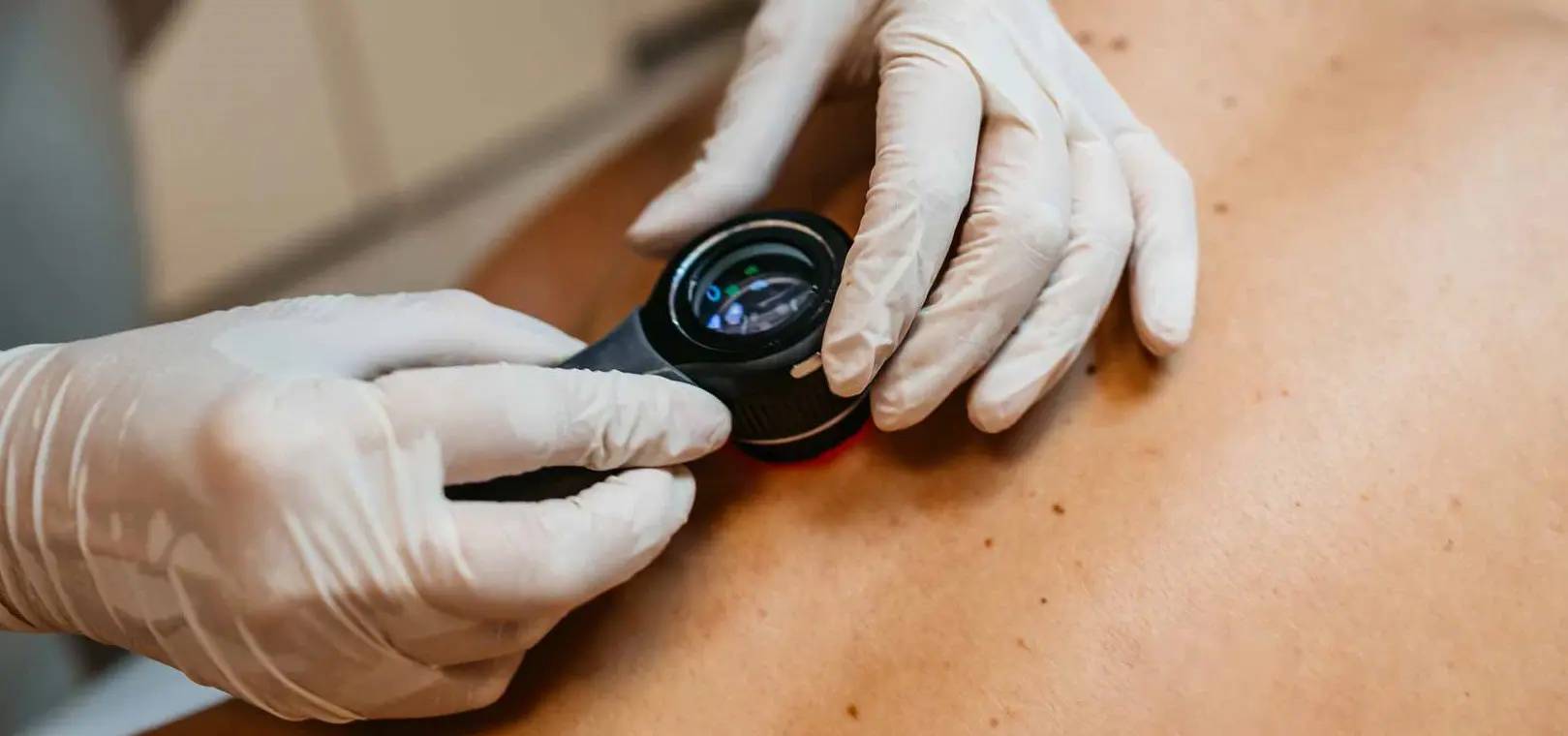 Un médecin examine la peau à la recherche de taches brunes