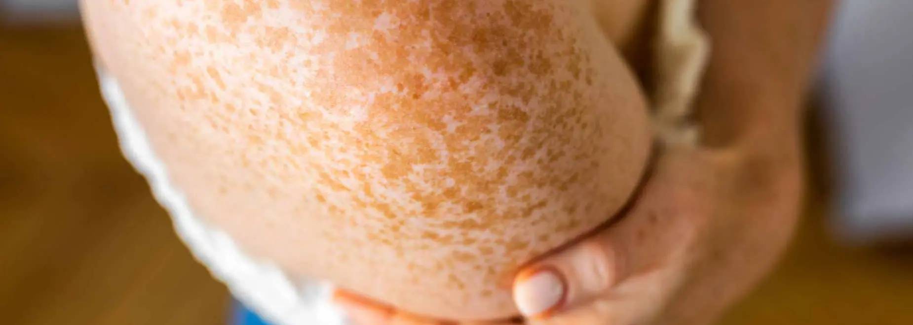 Melanin: Verantwortlich für Sommersprossen auf der Haut