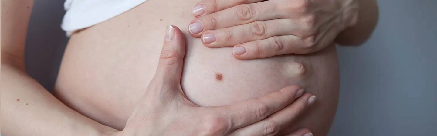 Grains de beauté pendant la grossesse