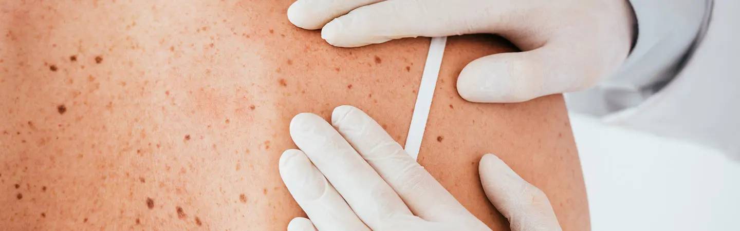 Un médecin examine des grains de beauté sur le dos d’un patient