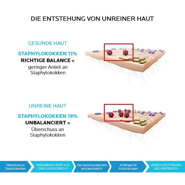 Grafik zur Entstehung von unreiner Haut: Obere Darstellung gesunder Haut mit 11% Staphylokokken in Balance, untere Darstellung unreiner Haut mit 19% Staphylokokken im Ungleichgewicht. Untereinander visualisiert der Text die Auswirkungen eines Ungleichgewichts im Mikrobiom (Barriere- und Hautverschlechterung)