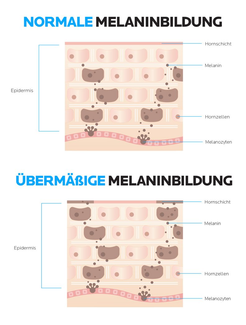 Melaninbildung in der Haut durch übermässige Sonneneinstrahlung