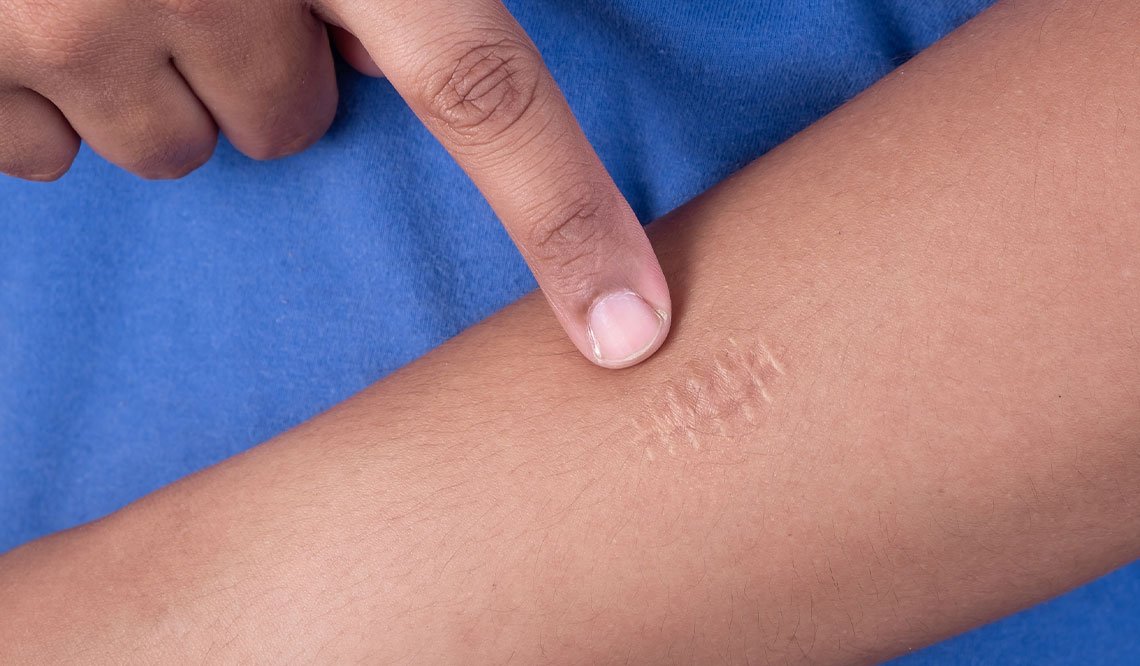 Larocheposay SubCategoryPage Damaged Scars and stitches