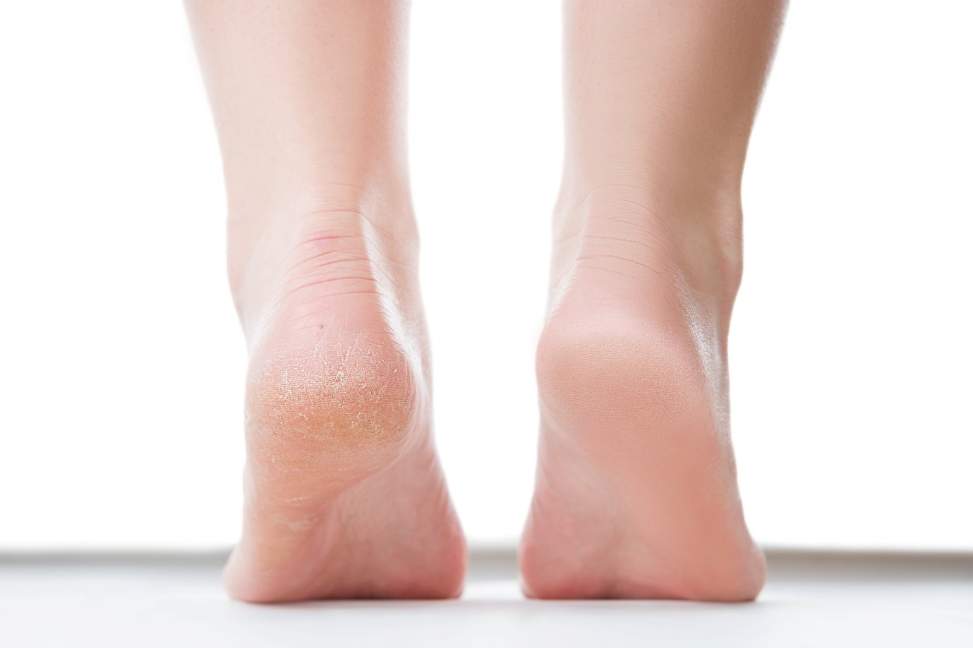 Deux pieds en appui sur les orteils avec des callosités uniquement sur celui de gauche