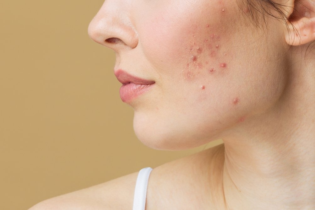 Vue de profil du bas du visage d'une femme avec des boutons d'acné
